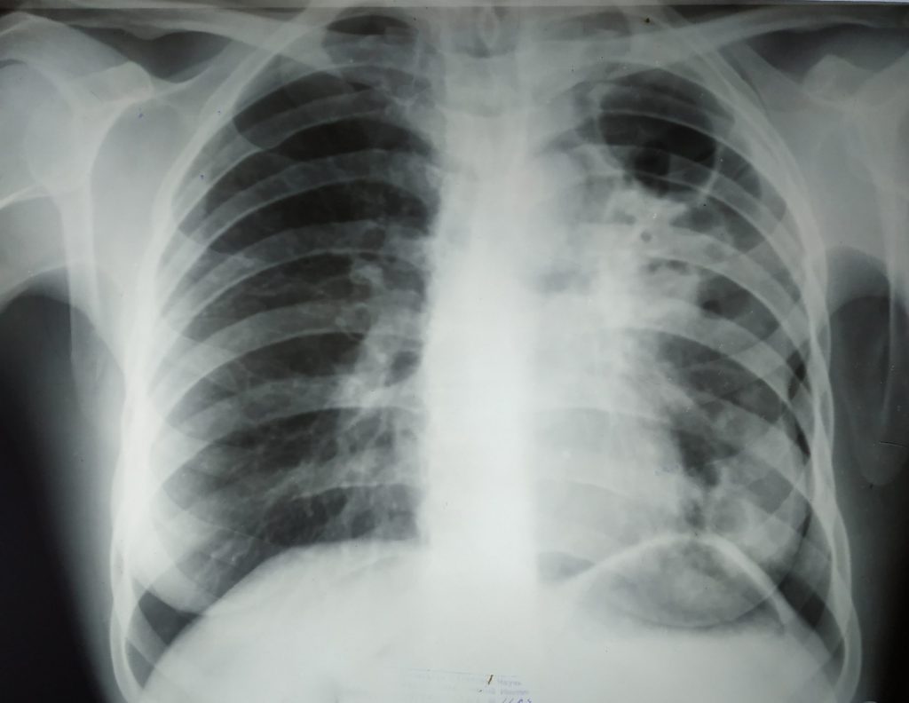 A chest X-ray showing fibrotic cavitary tuberculosis
