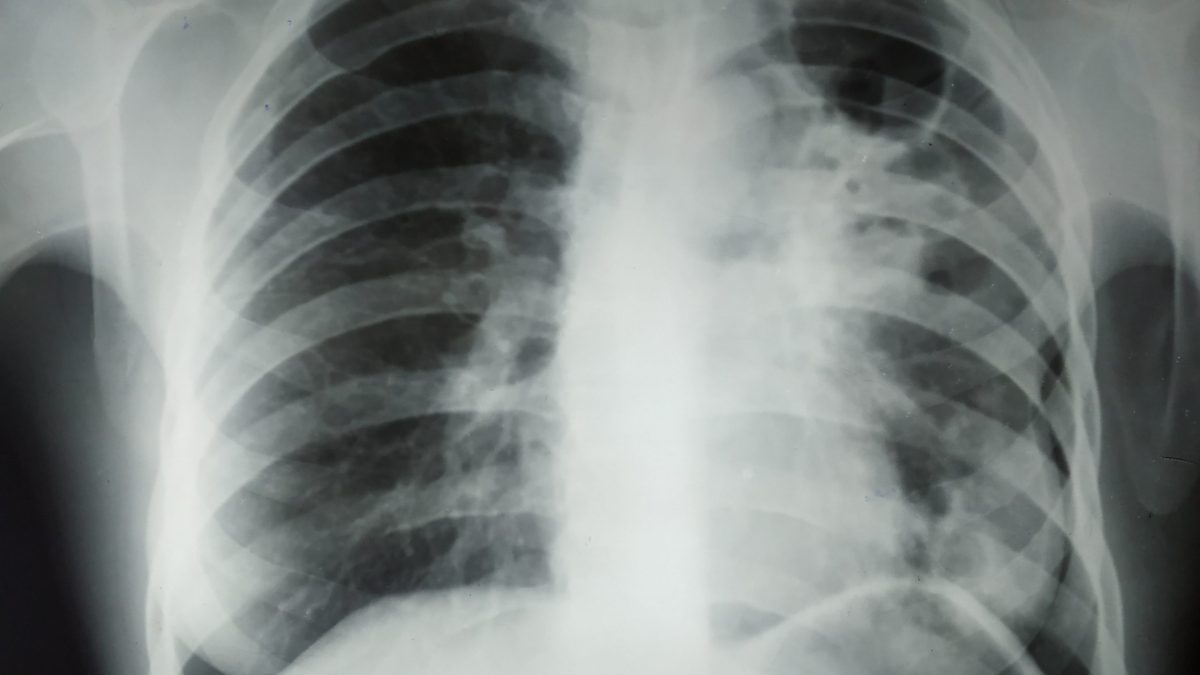 A chest X-ray showing fibrotic cavitary tuberculosis