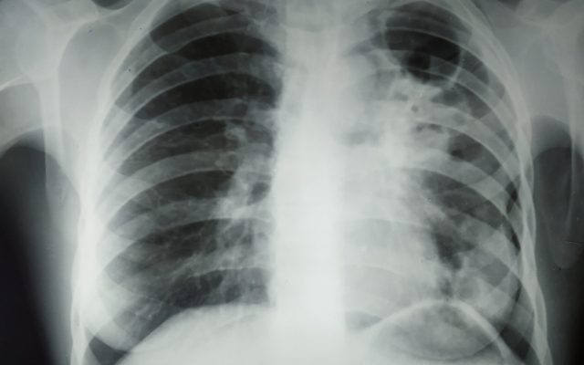 India’s TB Progress: Cases Down 21% Since 2015, but 28% of Global TB Deaths and ‘Missing’ Cases Remain